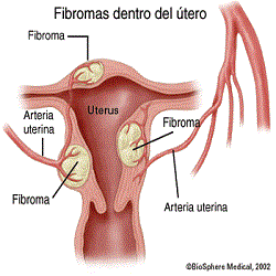 fibromas